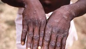 Caritas alerta estrutura diocesana a tomarem medida preventiva contra avaríola