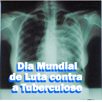 tuberculose